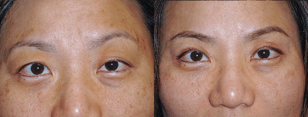 Eyelid Surgery Before & After Photos