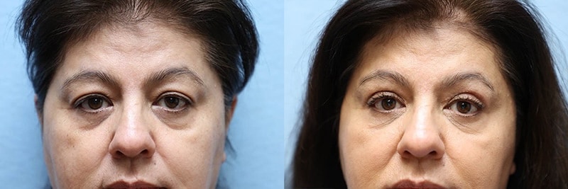 Eyelid surgery before and after
