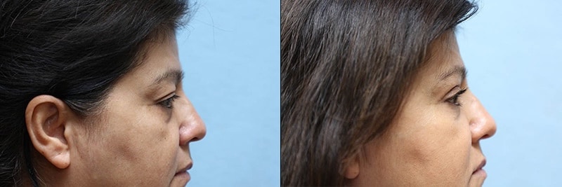 Eyelid surgery before and after