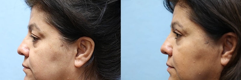 Eyelid surgery before and after