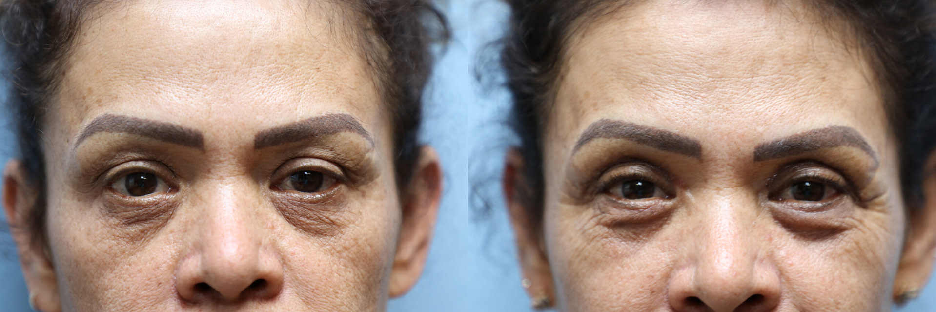 Eyelid Surgery Before & After Photos