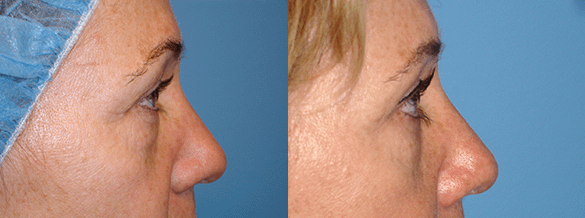 Eyelid Surgery Before & After Photos