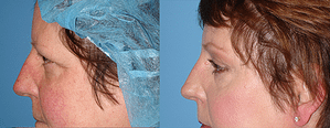 Eyelid Surgery Before & After Photos