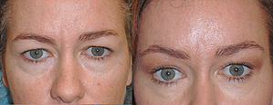 Eyelid Surgery Before & After Photos