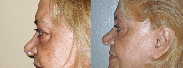 Eyelid Surgery Before & After Photos
