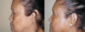 Eyelid Surgery Before & After Photos