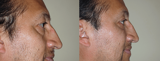 Eyelid Surgery Before & After Photos