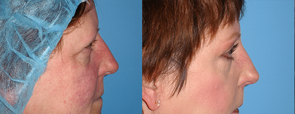 Eyelid Surgery Before & After Photos