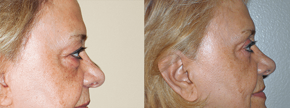 Eyelid Surgery Before & After Photos