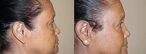 Eyelid Surgery Before & After Photos
