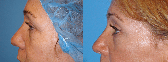 Eyelid Surgery Before & After Photos