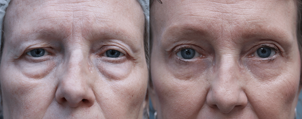 Brow Lift Orange County Before & After Photos