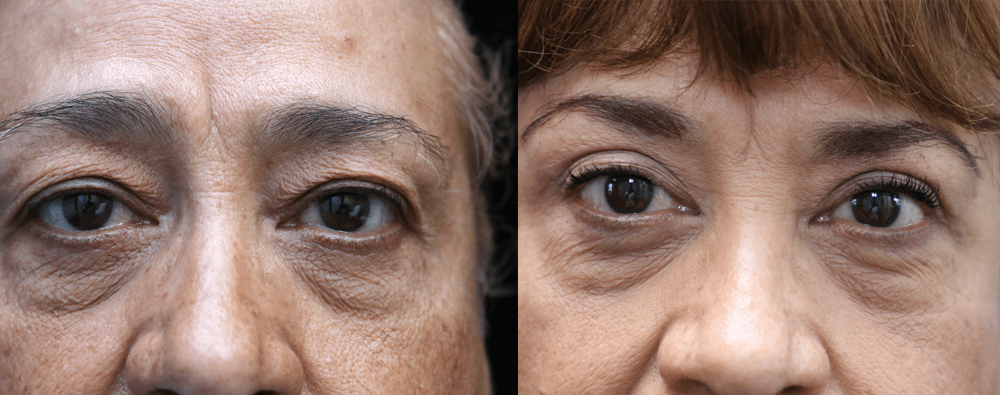 Eyelid Surgery Before & After Photos