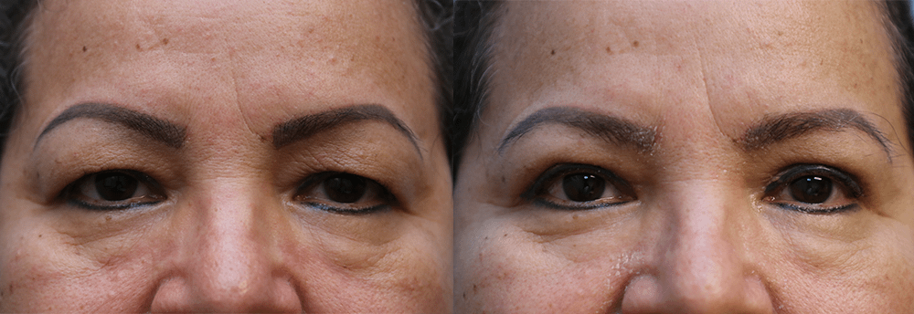 Eyelid Surgery before and after