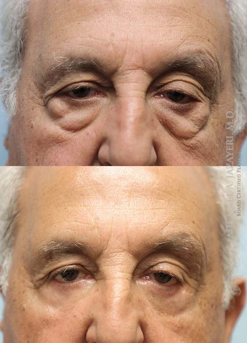 Eyelid surgery before and after