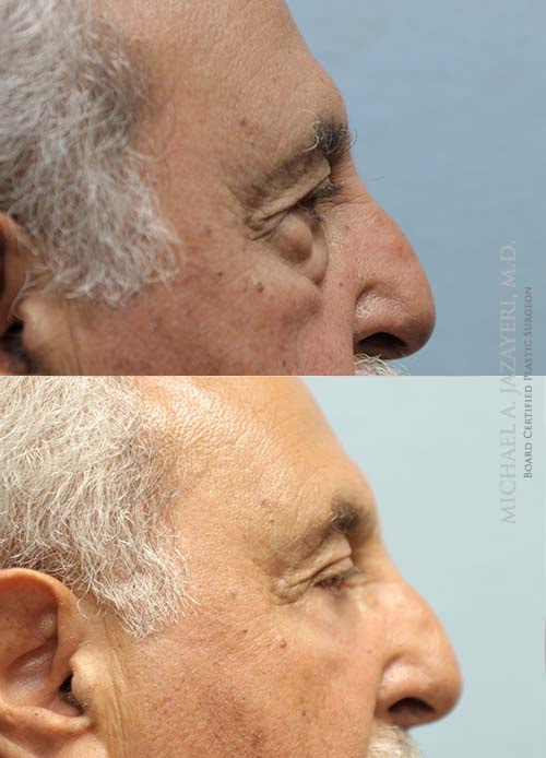 Eyelid surgery before and after
