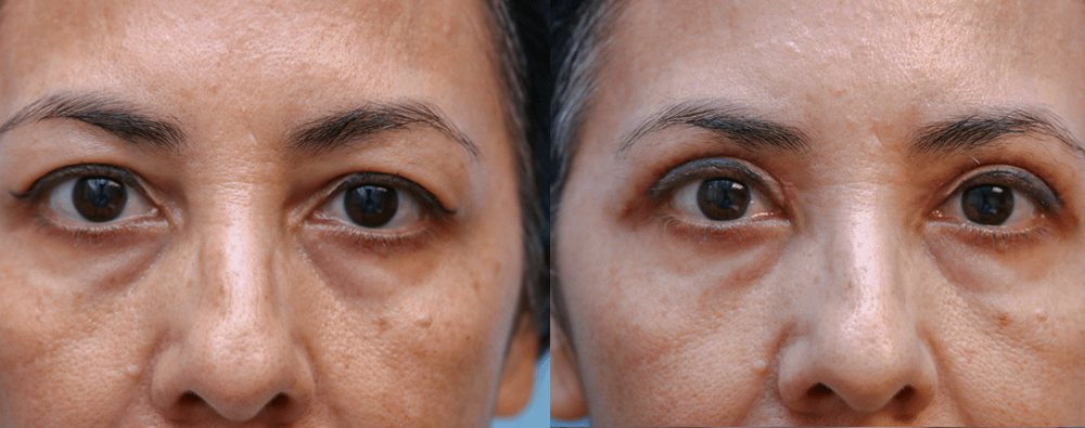 eyelid surgery Before & After Photos