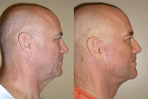 Face & Neck Lift for Men Before & After Photos