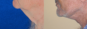 Face & Neck Lift for Men Before & After Photos