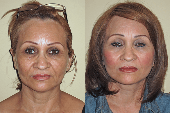 Face and Neck Lift Before & After Photos Front