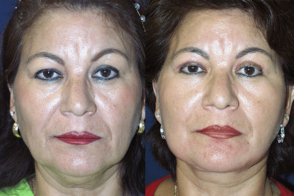 Face and Neck Lift Before & After Photos Front