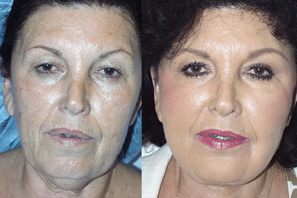 Face and Neck Lift Before & After Photos Front