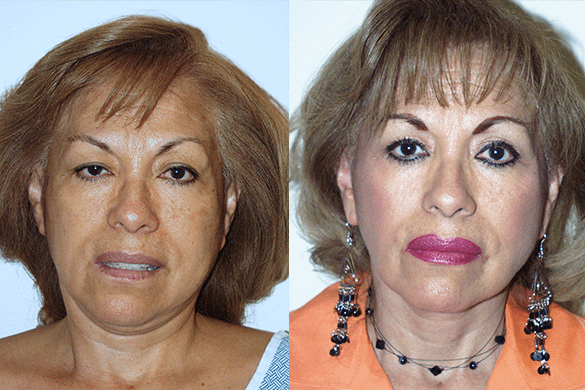 Face and Neck Lift Before & After Photos