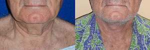 Face and Neck Lift Before & After Photos Front