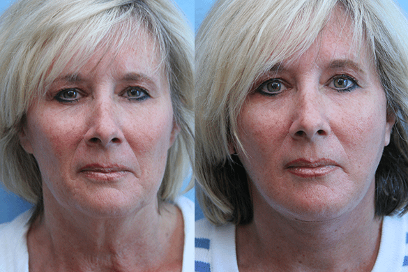 Face and Neck Lift Plastic Surgery Before & After Photos