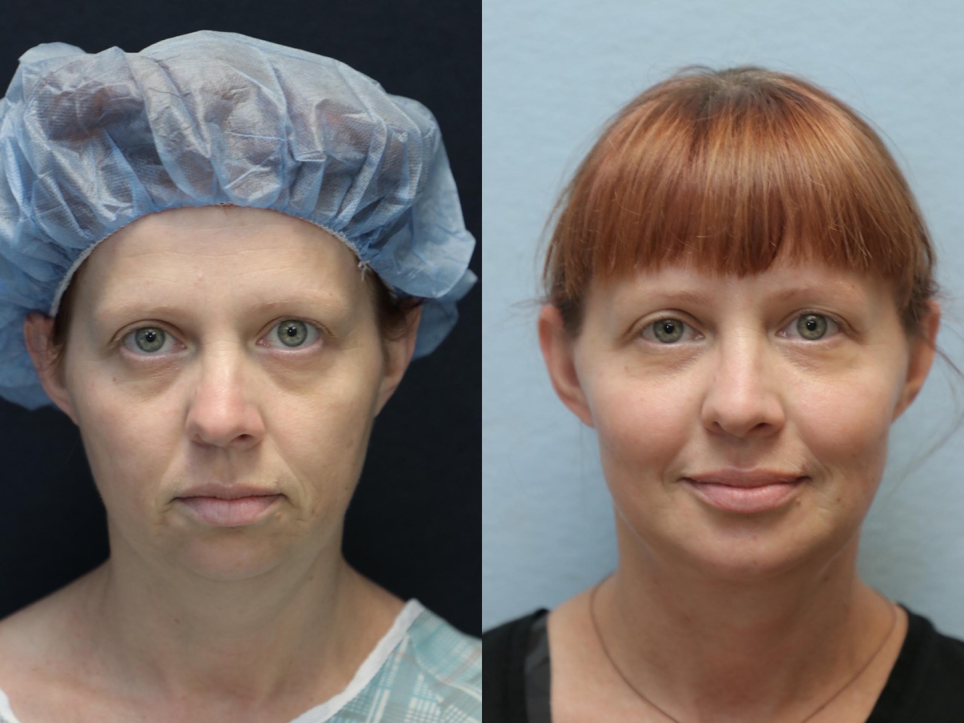 facelift and neck lift before and after front
