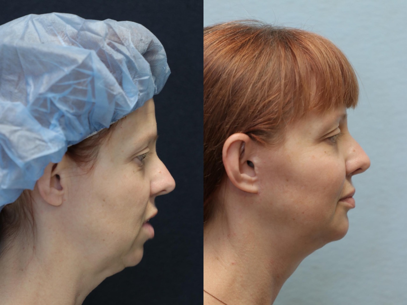 facelift and neck lift before and after right