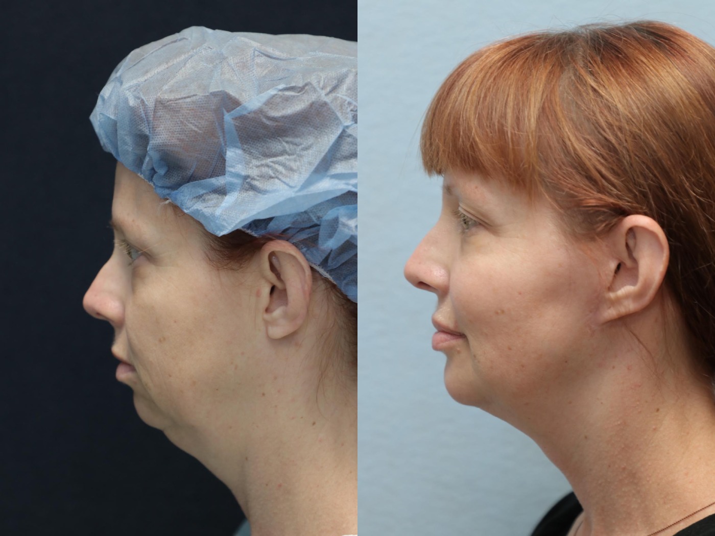 facelift and neck lift before and after left
