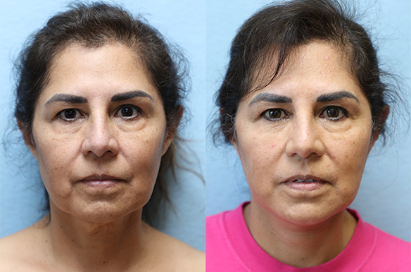 facelift and neck lift before and after front