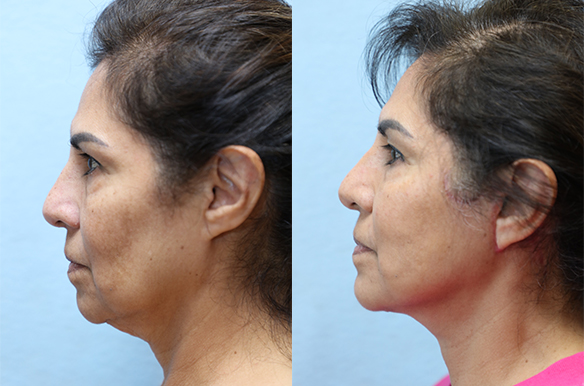facelift and neck lift before and after left