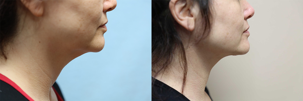 facelift and neck lift before and after right