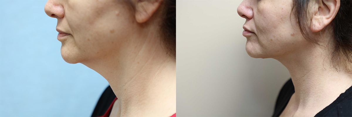 facelift and neck lift before and after left