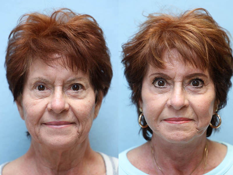 facelift and neck lift before and after right