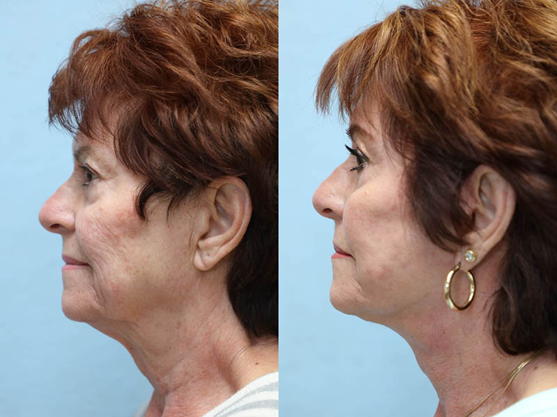 facelift and neck lift before and after left