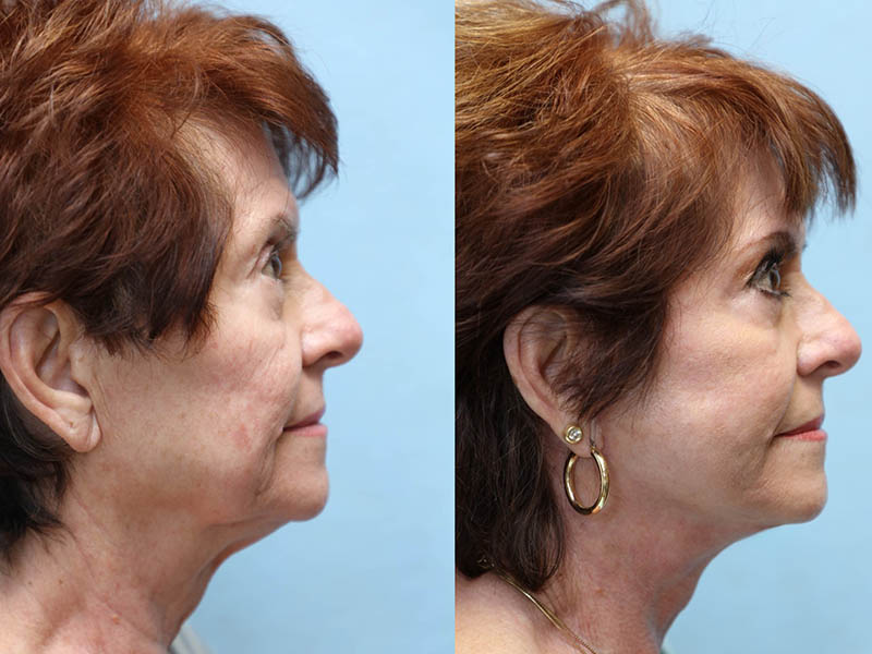 facelift and neck lift before and after left