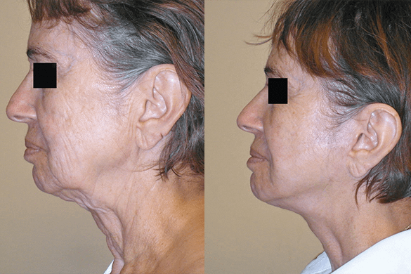 Face and Neck Lift Before & After Photos Left