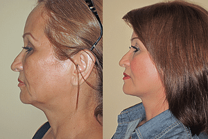 Face and Neck Lift Before & After Photos Left