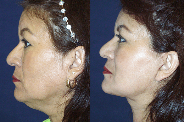 Face and Neck Lift Before & After Photos Left