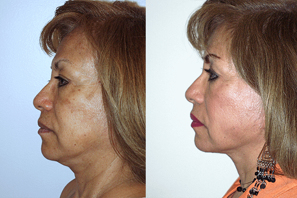 Face and Neck Lift Before & After Photos Left