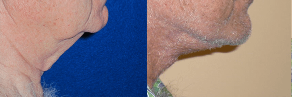 Face and Neck Lift Before & After Photos Right