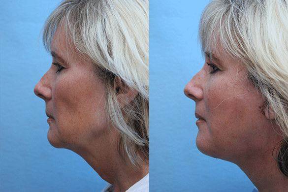 Face and Neck Lift plastic surgery Before & After Photos