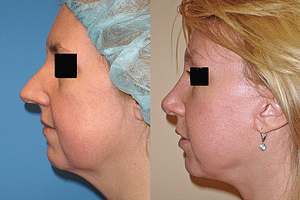 Face and Neck Lift Before & After Photos Right
