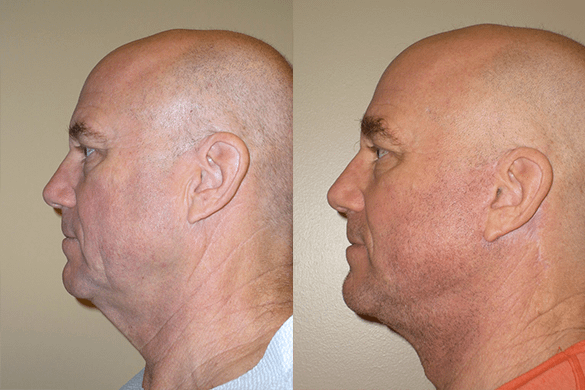 Face and Neck Lift Before & After Photos Left