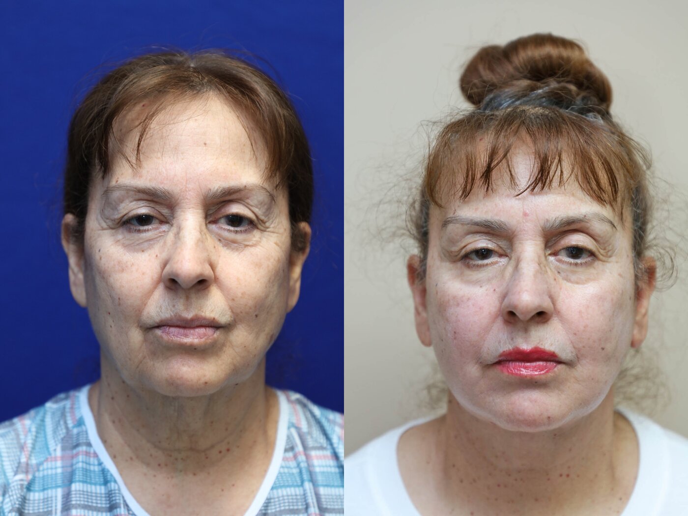 facelift and neck lift before and after right