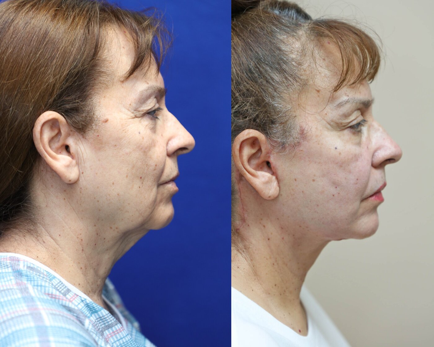 facelift and neck lift before and after left