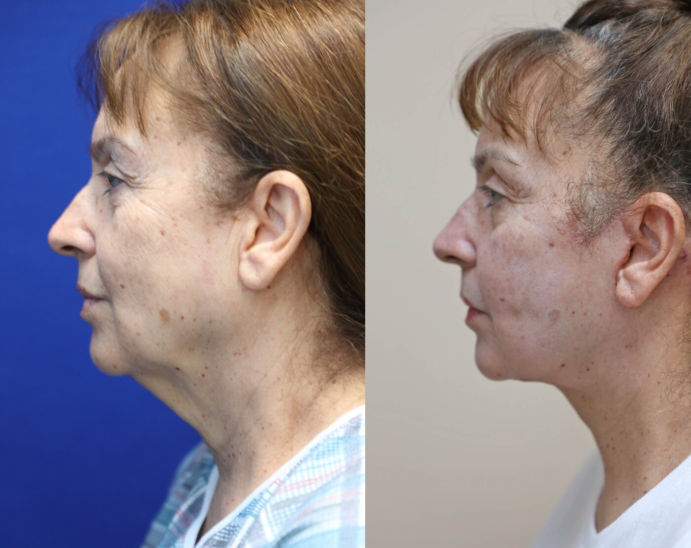facelift and neck lift before and after left